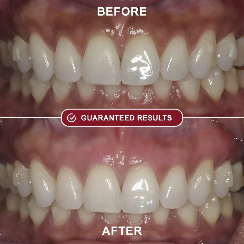 Nydras™ - Teeth Whitening Kit Roeboost Store