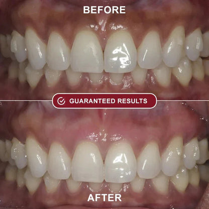 Nydras™ - Teeth Whitening Kit Roeboost Store