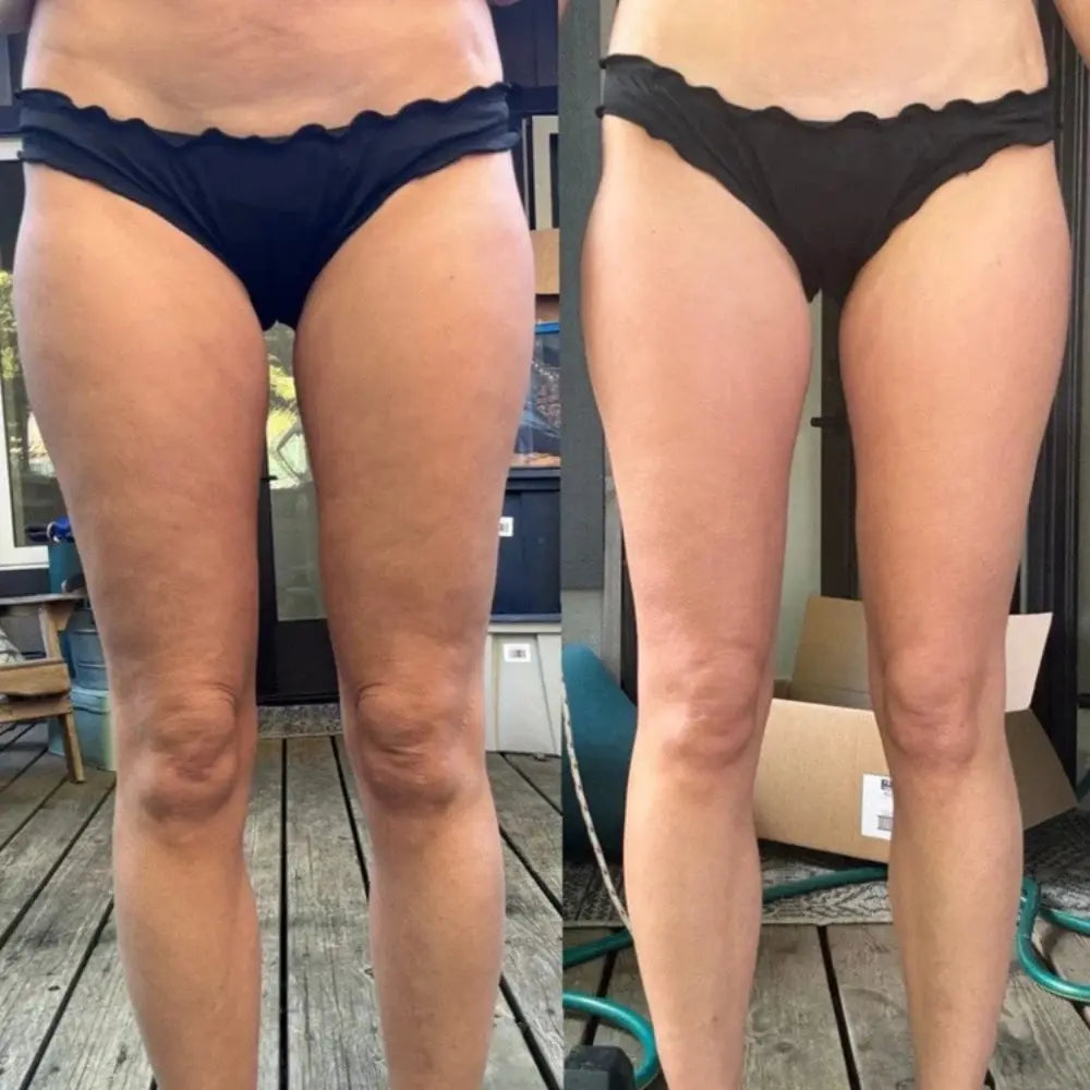 CelluGlow™ - Anti-Cellulite Massager Nydras